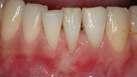 歯周病にて下がった歯茎への移植