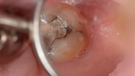 歯の破折の診断