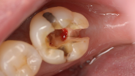 歯の破折の診断