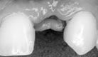 入れ歯の場合の写真