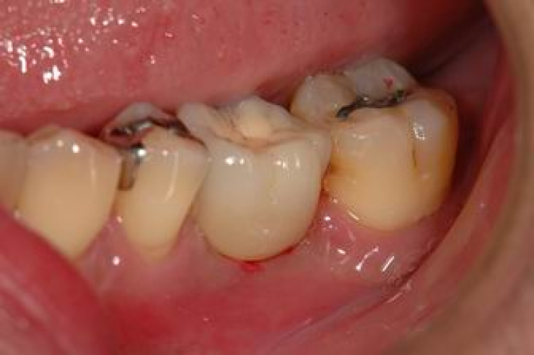 よしたに歯科医院のコラム 症例報告　臼歯部1歯欠損