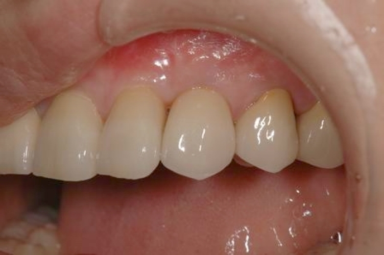 よしたに歯科医院のコラム 症例報告　上顎犬歯１歯欠損インプラント