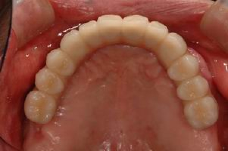 よしたに歯科医院のコラム インプラント症例　上顎無歯顎ボーンアンカードブリッジ
