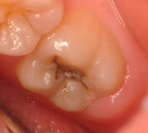 caries01.jpg