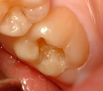 caries02.jpg