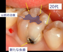 caries05.jpg