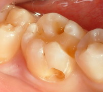 caries06.jpg