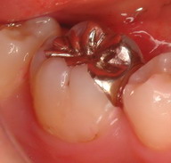 caries07.jpg