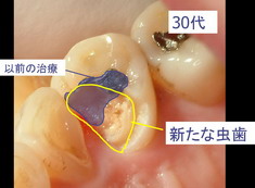 caries09.jpg