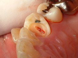 caries10.jpg