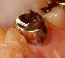 caries13.jpg