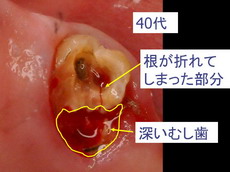 caries15.jpg