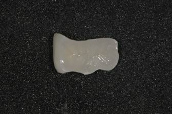 ceramicinlay02.jpg